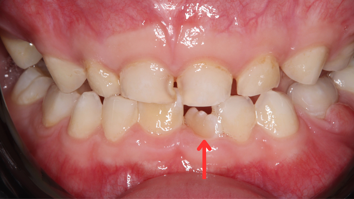 Кейс Олеси Викторовны: маленький пациент с тортоаномалией до начала лечения.