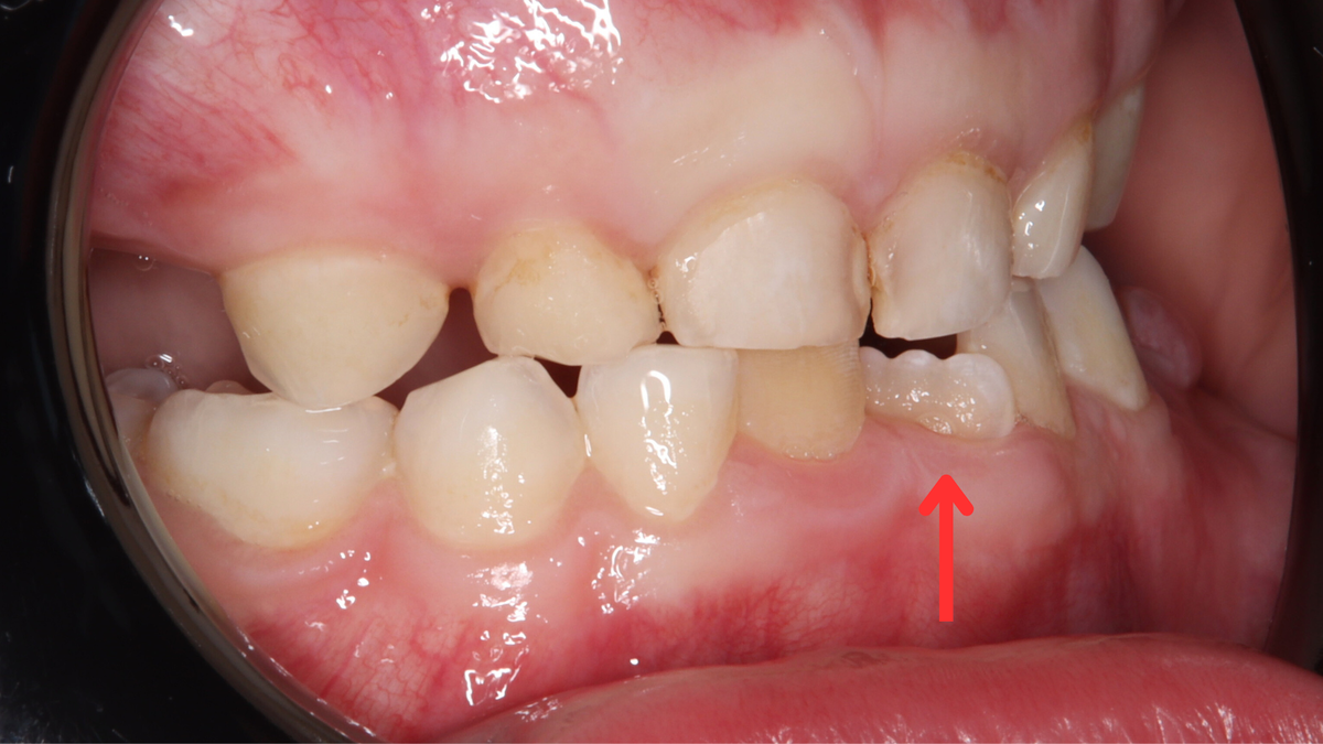 Кейс Олеси Викторовны: маленький пациент с тортоаномалией до начала лечения.
