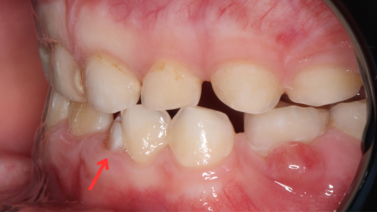 Кейс Олеси Викторовны: маленький пациент с тортоаномалией до начала лечения.