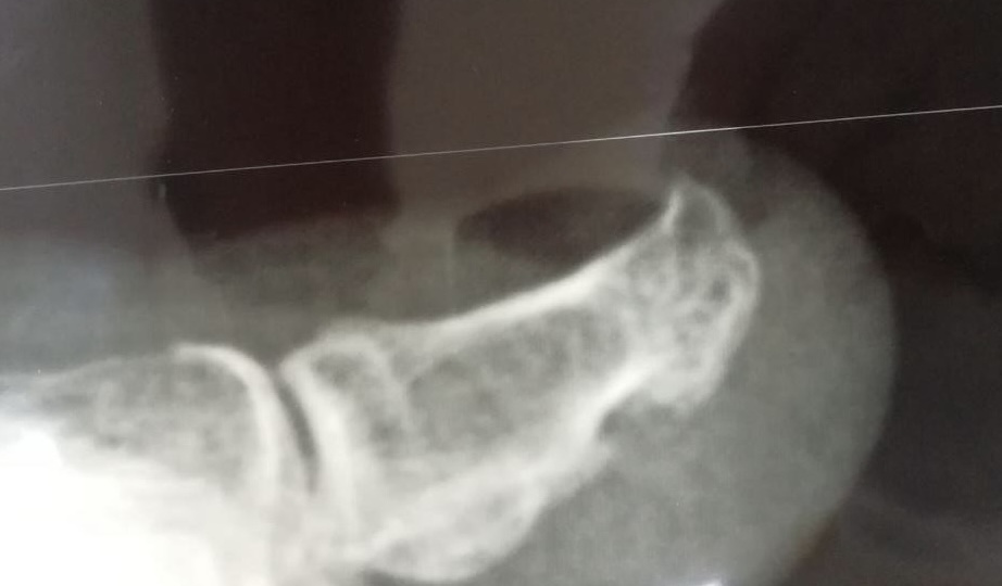 Ноготь медленно растёт, и палец болит