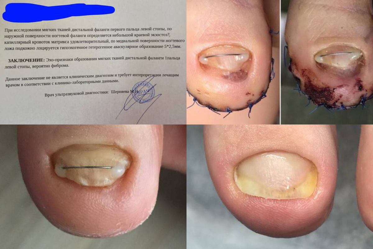 Прооперированный палец