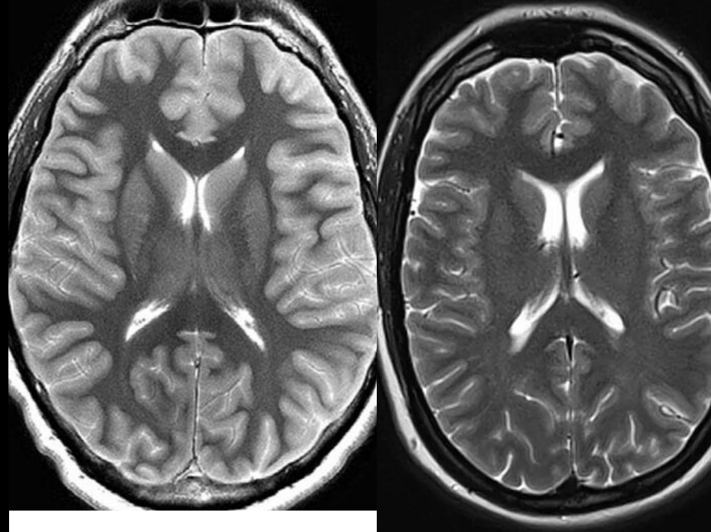 Сравнение коры мозга на МРТ Т2-ВИ живого человека (справа) и человека после перенесенной клинической смерти на первые сутки (слева). Кроме повышения сигнала от коры отмечается сужение боковых желудочков мозга и его борозд, обусловленное отеком.