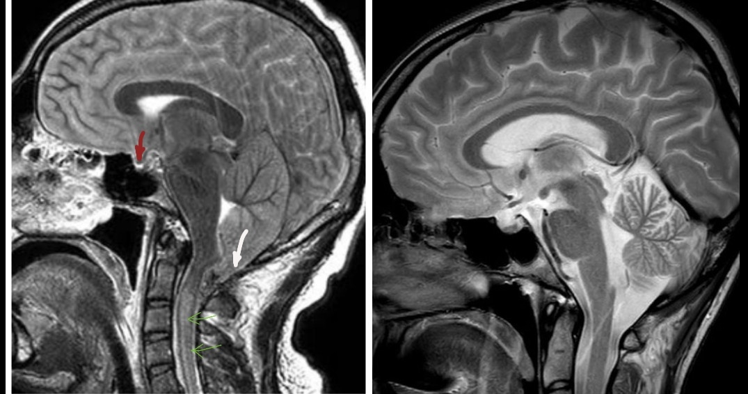 Вклинение мозжечка в БЗО (показано белой стрелкой), гипоталамуса в турецкое седло (красной), сдавление цистерн основания мозга и водопровода. Повышение сигнала от спинного мозга (зелёные стрелки). Деформация вентральной поверхности мозга.