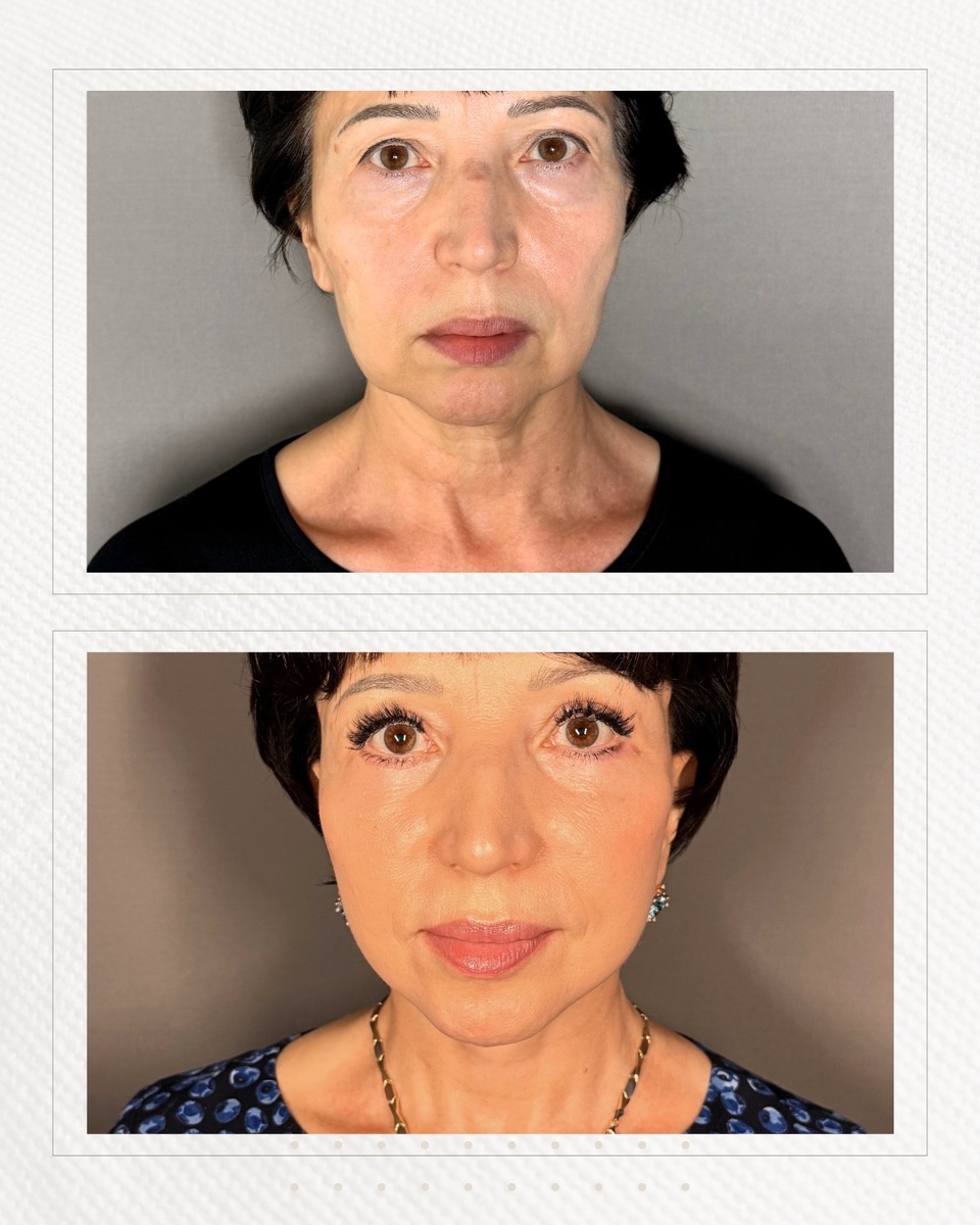 Фото после смас подтяжки