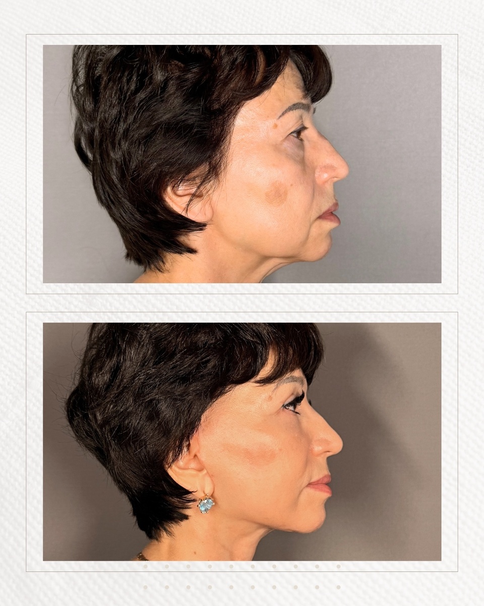 Фото после смас подтяжки