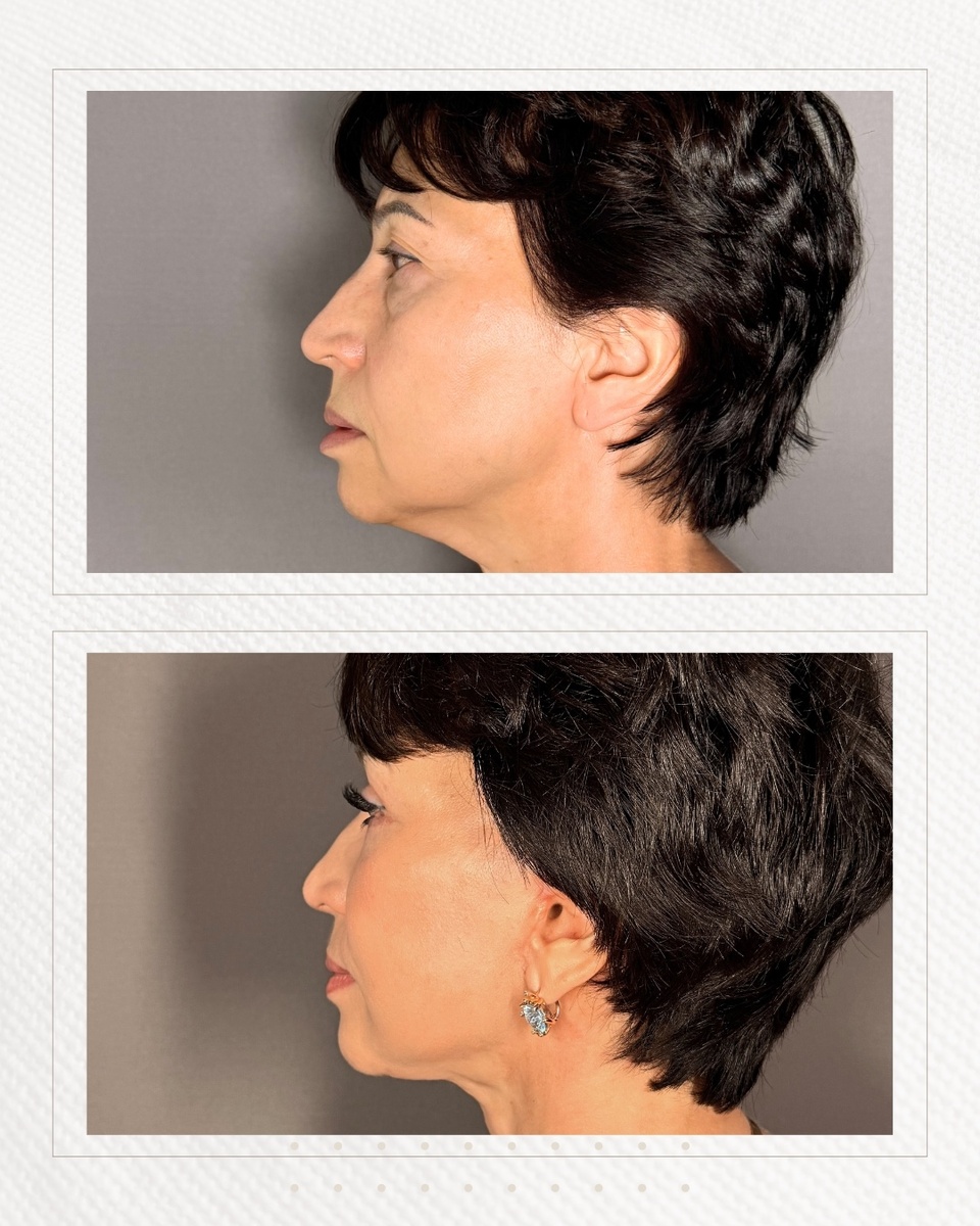 Фото после смас подтяжки