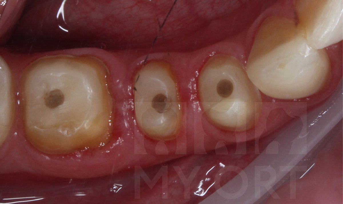 Три зуба обработаны под постоянные коронки из диоксида циркония 