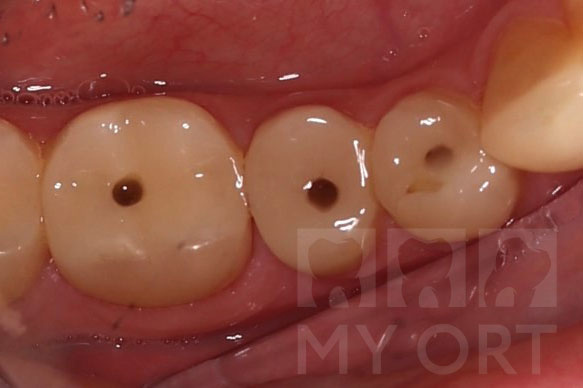 Установлены стекловолоконные штифты 