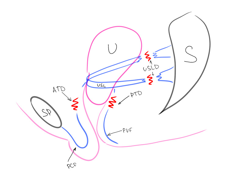 Рис. 1 (ATD – передний поперечный дефект, PTD – задний поперечный дефект, PCF – пубоцервикальная фасция, RVF – ректовагинальная фасция, S – крестец, SP – лобковый симфиз, U – матка, USLD – дефект крестцово-маточных связок, USL - крестцово-маточная связка)