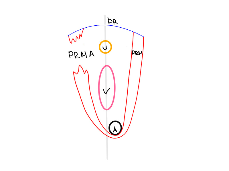 Рис. 2 (PR – нижняя ветвь лобковой кости, PRM –пуборектальная мышца, PRMA - отрыв пуборектальной мышцы, U – уретра, V-влагалище, A – анус)