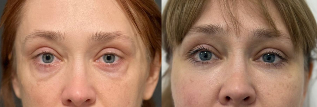 Трансконъюнктивальнуая блефаропластика — удаление грыж без внешних швов. Фото до и после. Фото с сайта хирурга Д.Р. Гришкяна. Имеются противопоказания, требуется консультация специалиста.