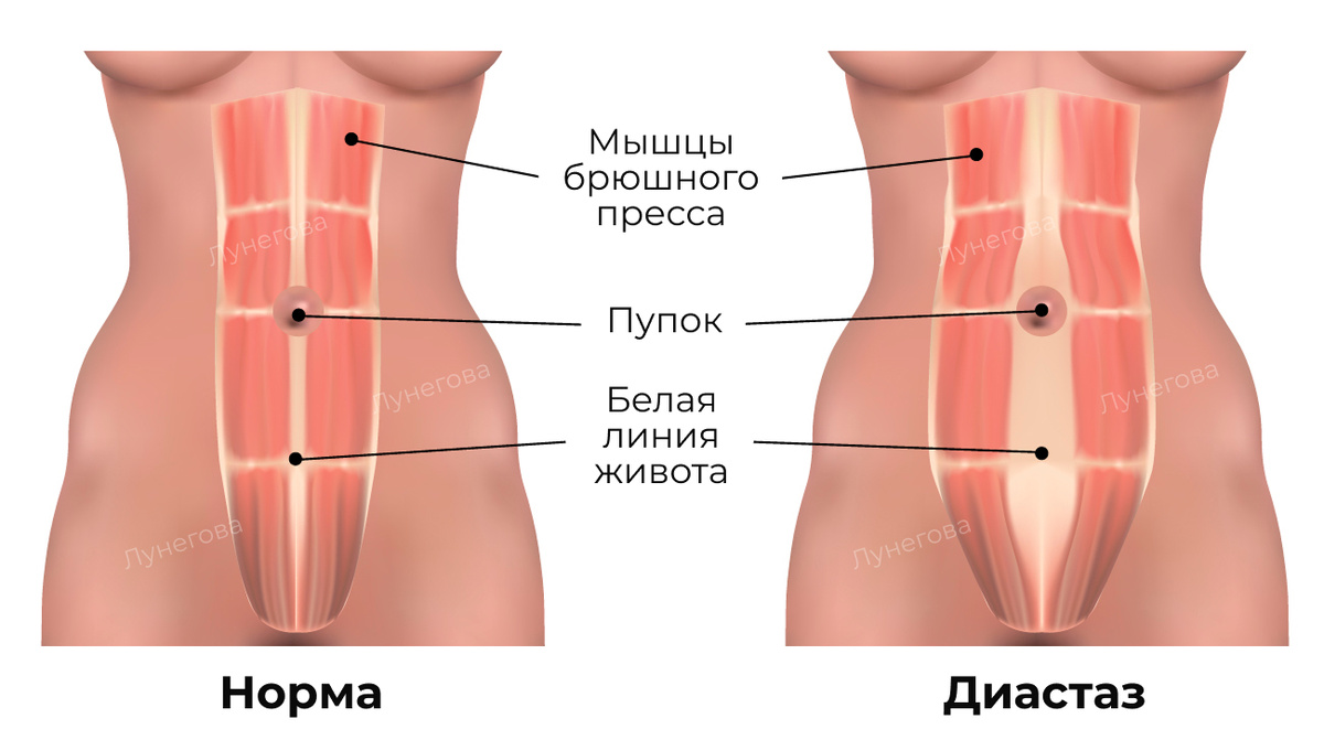 Сравнение нормы и диастаза прямых мышц живота.