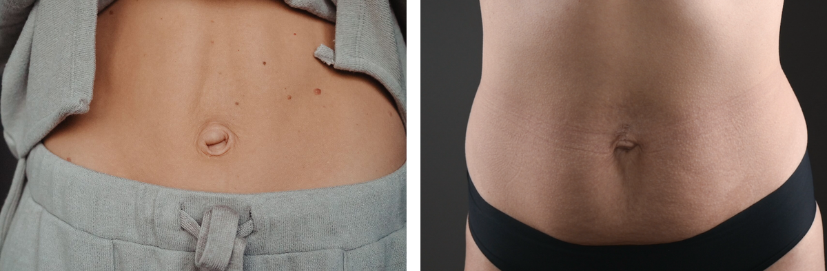 Как может выглядеть диастаз у женщин