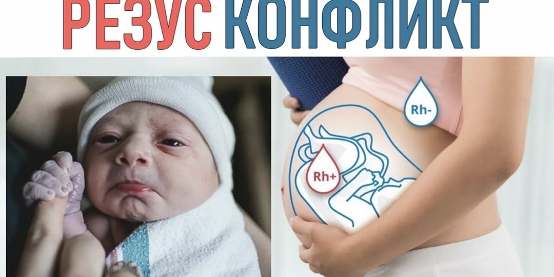 Резус-конфликт — что должна знать каждая беременная