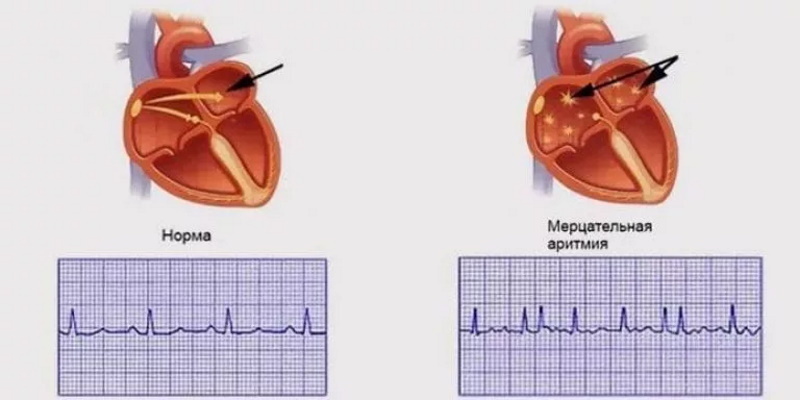 Когда сердце сбивается с ритма. Всё, что важно знать о мерцательной аритмии