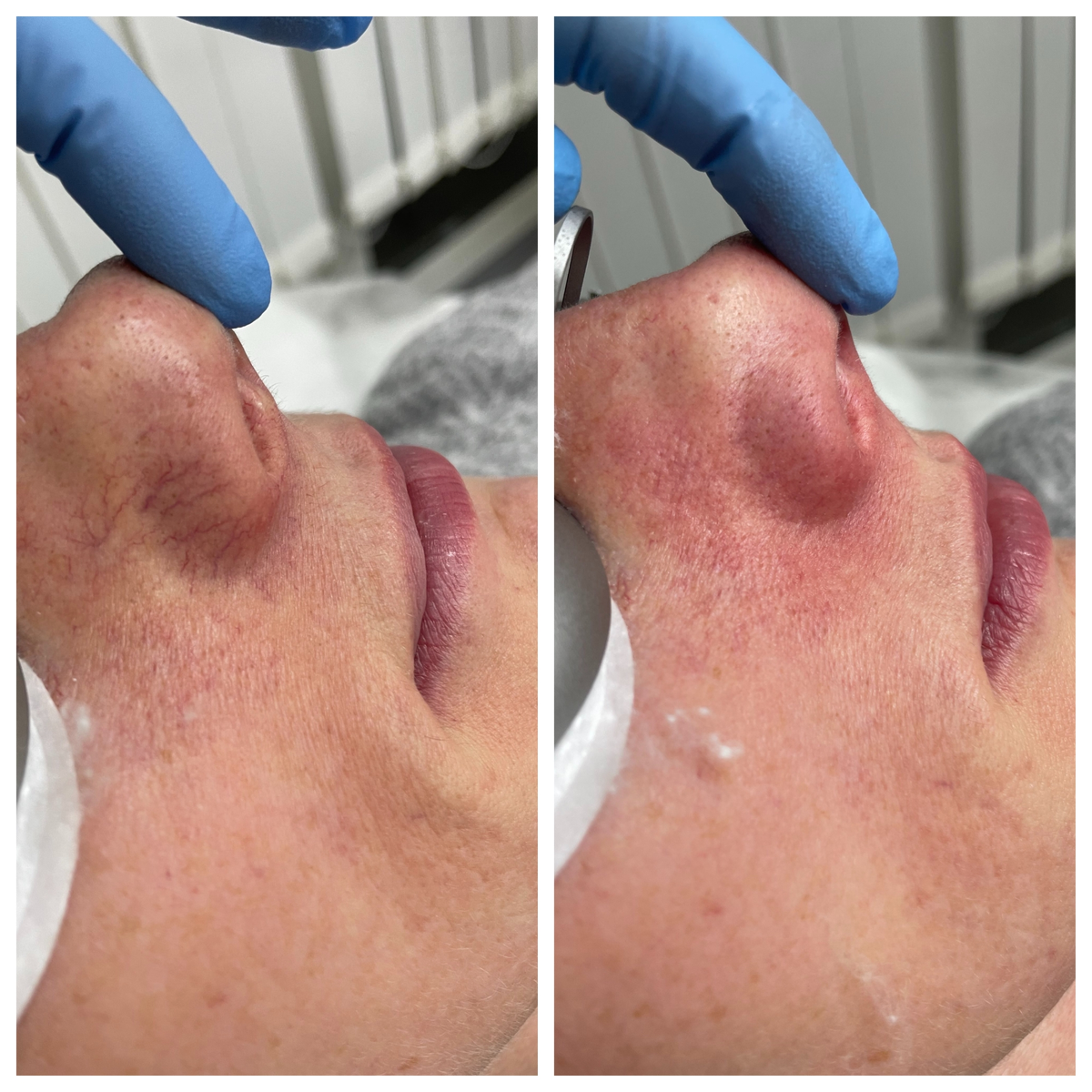 Фото До/После применения лазера