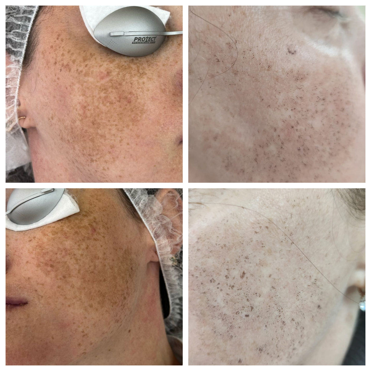 Фото До/После процедуры