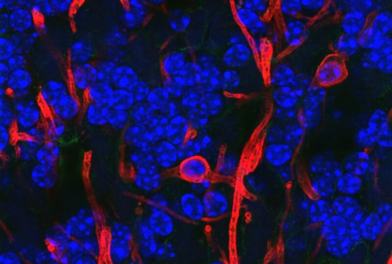 Выключение воспаления поможет при редком генетическом заболевании мозга