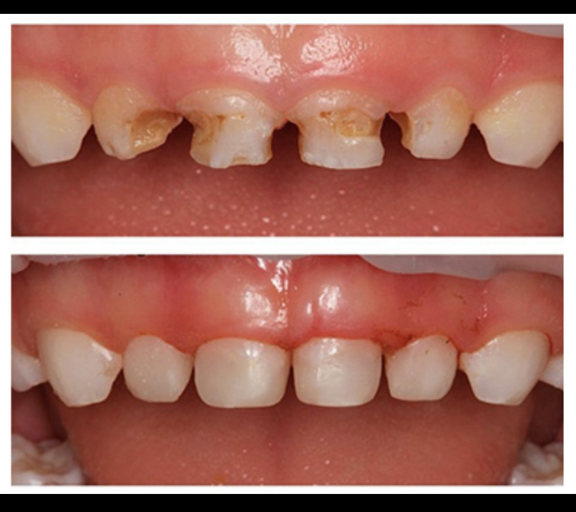 Кариес молочных зубов