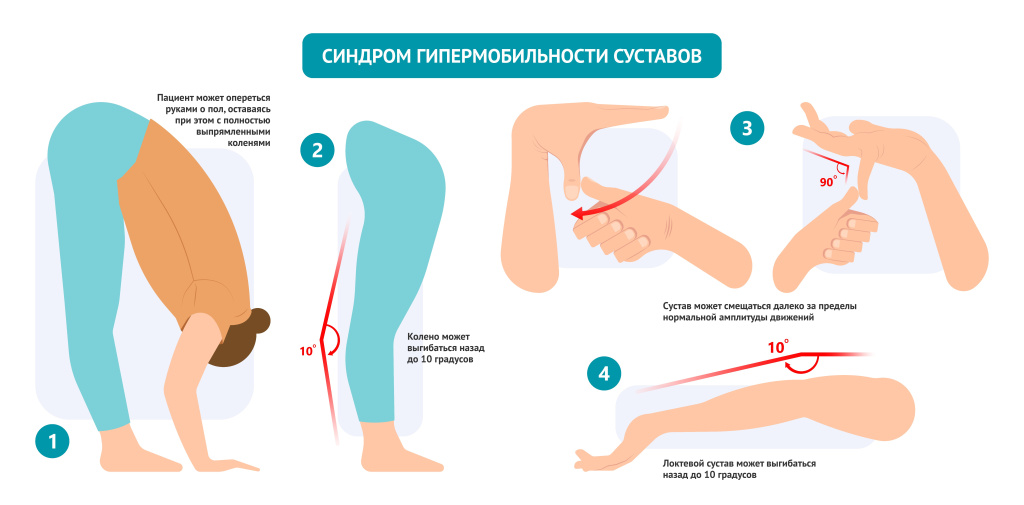 Каждый 5 человек — диспластик. А вы?