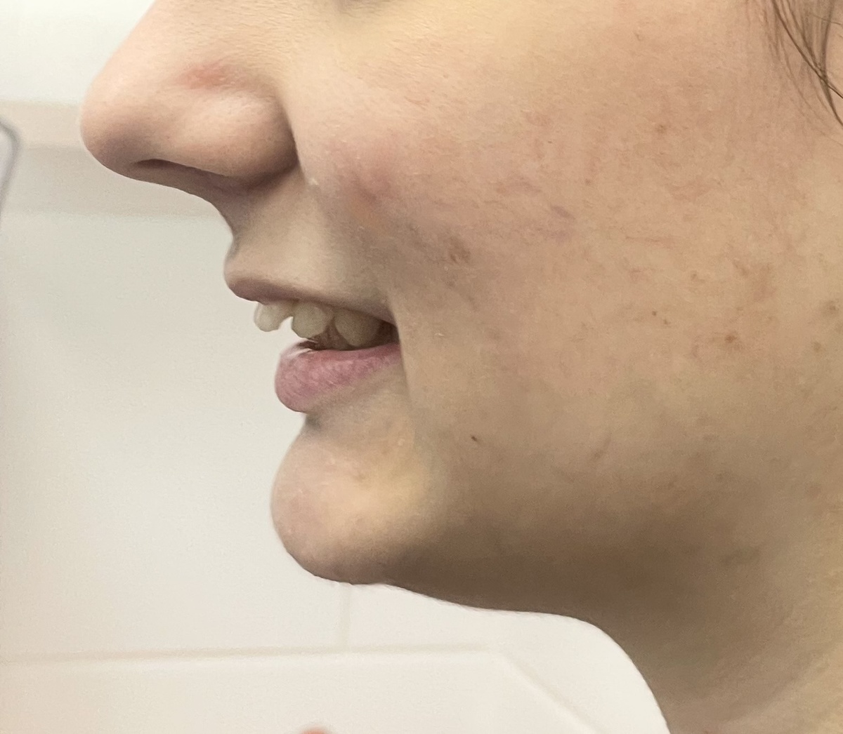 Дистальный прикус