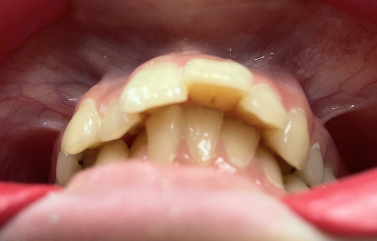 Саггитальная щель