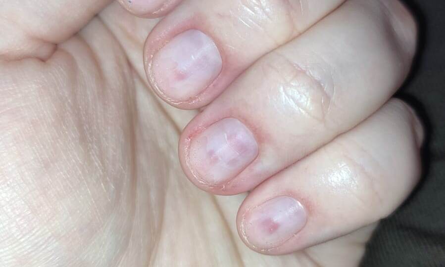 Синяки под ногтями после снятия гелевого покрытия. Что делать и кто виноват?