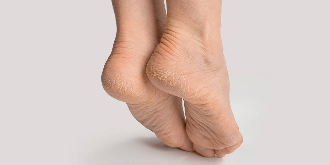 Трескаются пятки — не только обувь виновата