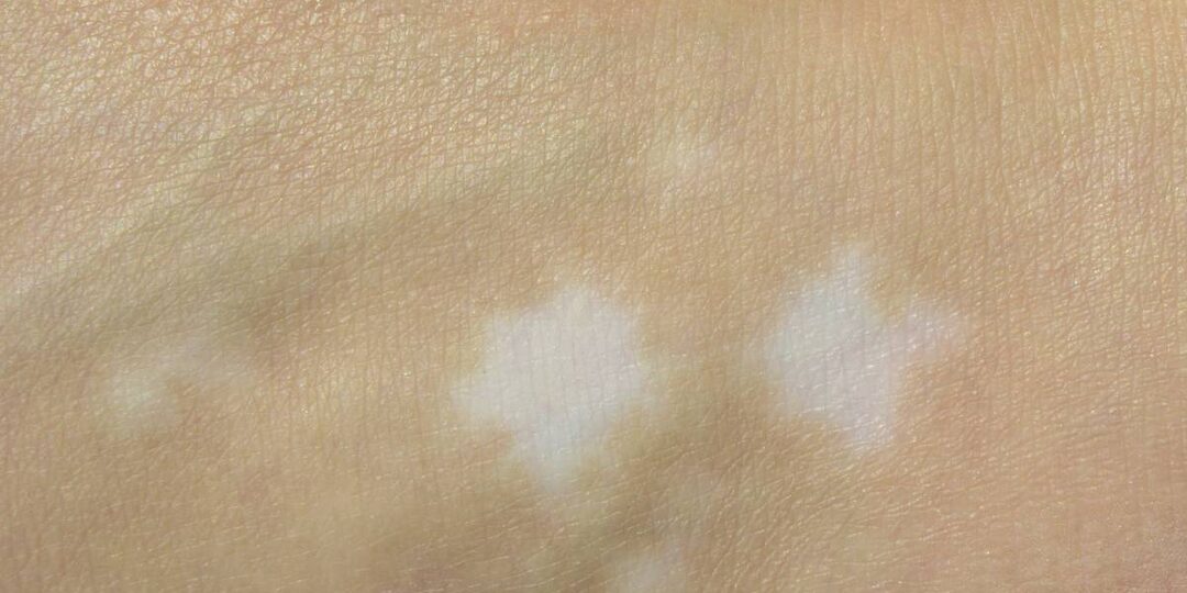 Белые пятна на коже — когда это не просто косметика