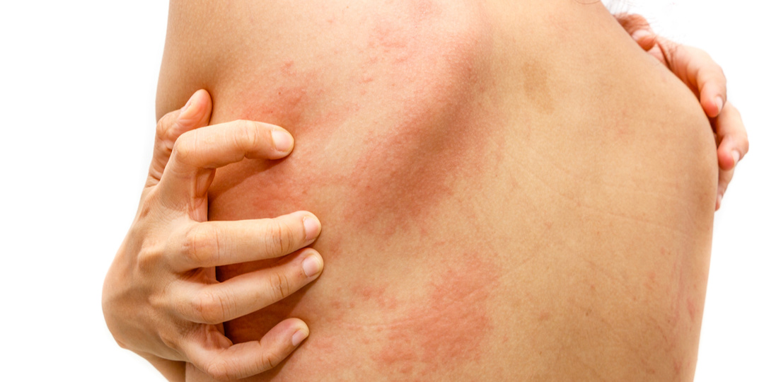 Сильный зуд спины без видимой причины