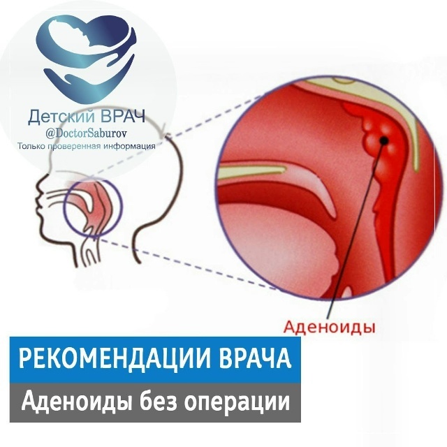 Аденоиды БЕЗ ОПЕРАЦИИ 👦 Артур Сабуров. Детский врач. Остеопат. Курсы для мам