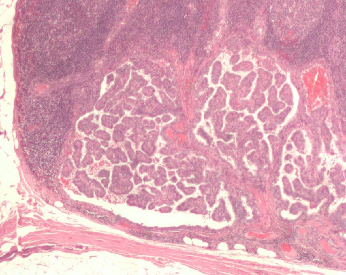   Метастатическое поражение лимфатического узла при папиллярном раке щитовидной железы. Микрофотография / © Nephron / Wikipedia