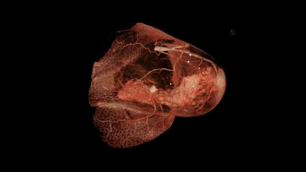    Раковая опухоль на снимке компьютерной томографии груди / © Rsmskns, Wikipedia