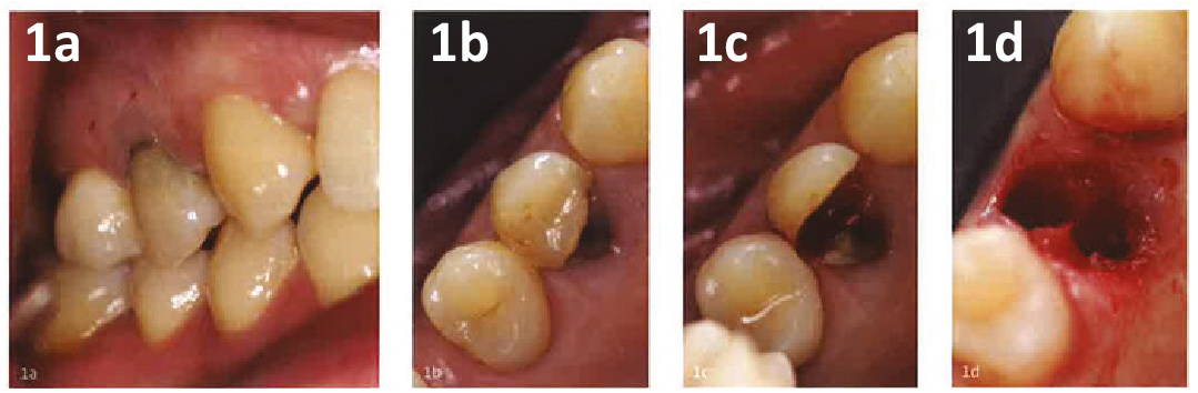Рис. 1 a-d Клинический случай: предоперационный снимок зуба с вертикальным переломом. Удаление.
