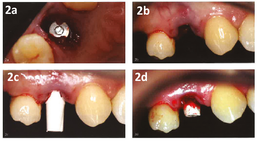 Рис. 2 a-d Клинический случай: снимок расположения имплантата на уровне альвеолярного гребня, присоединение и обточка абатмента.