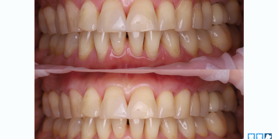 Две большие операции на десне: как мы подготовили пациента к ортодонтии.