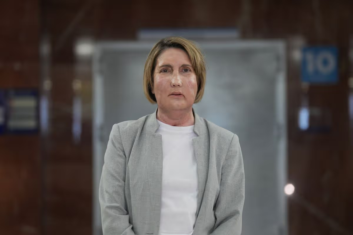 Карме потеряла свое лицо после серьезных осложнений со здоровьем, вызванных укусом насекомого (Фото: Дэвид Зорракино / Avalon).