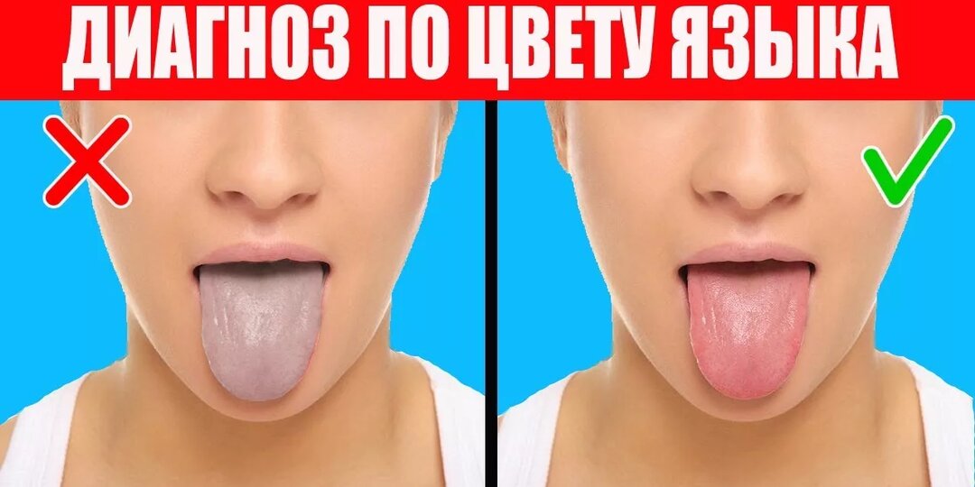 Что можно "прочитать" по языку: какие проблемы со здоровьем видны.