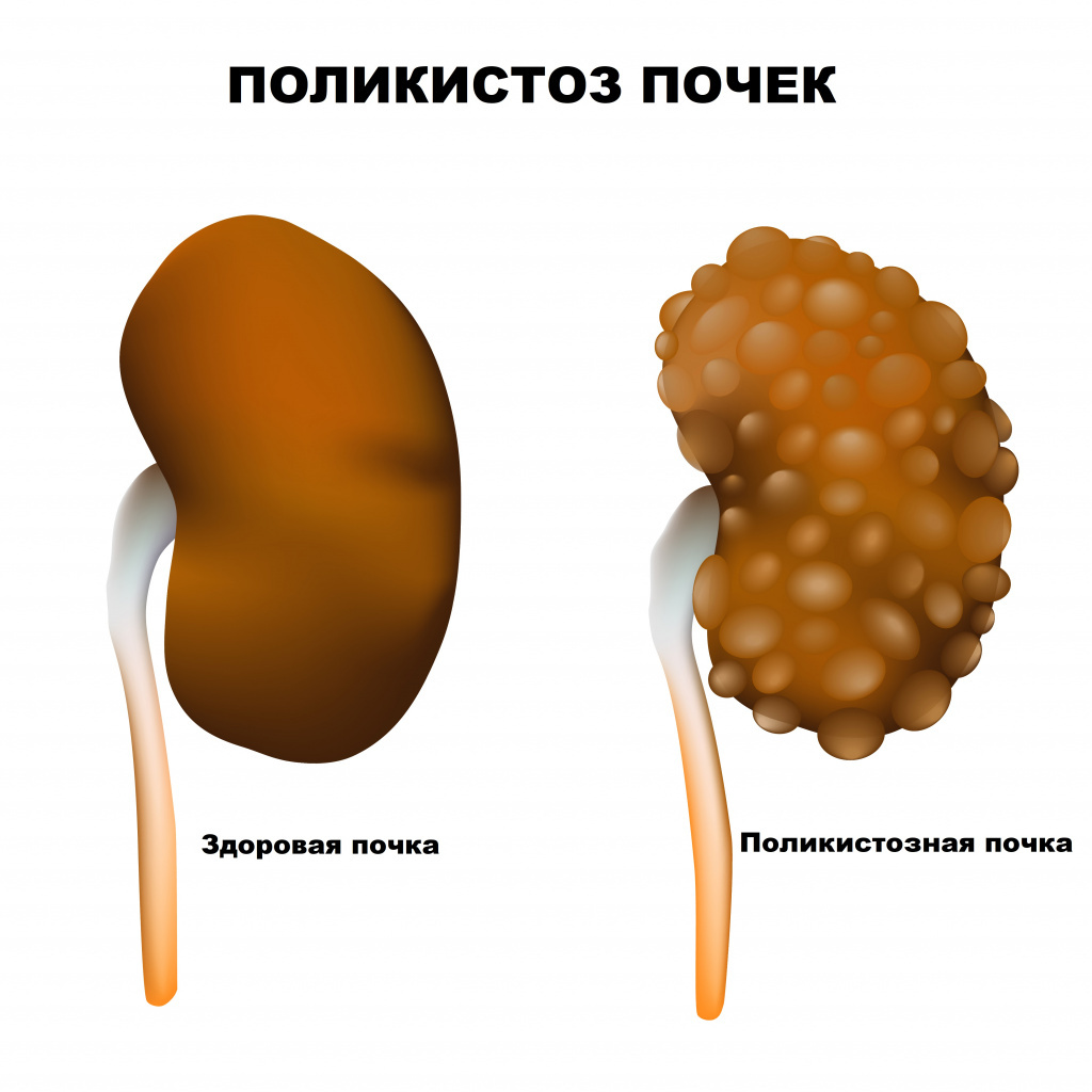 Поликистоз почек. Источник: invitro.ru