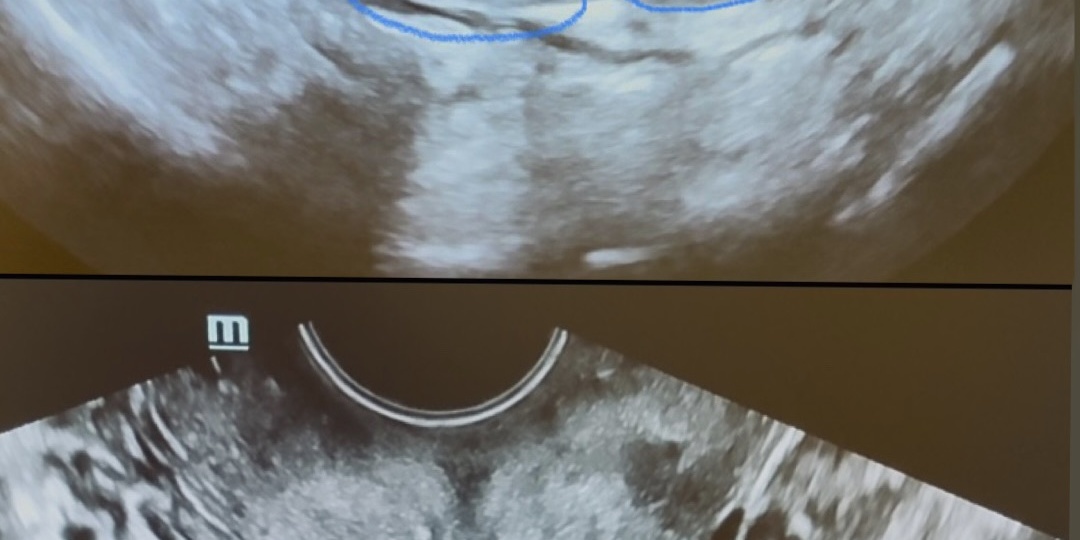 Двойная матка - двойные расходы
