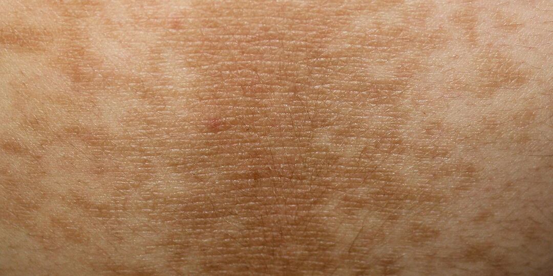 Темные пятна на коже — возможный сигнал изнутри