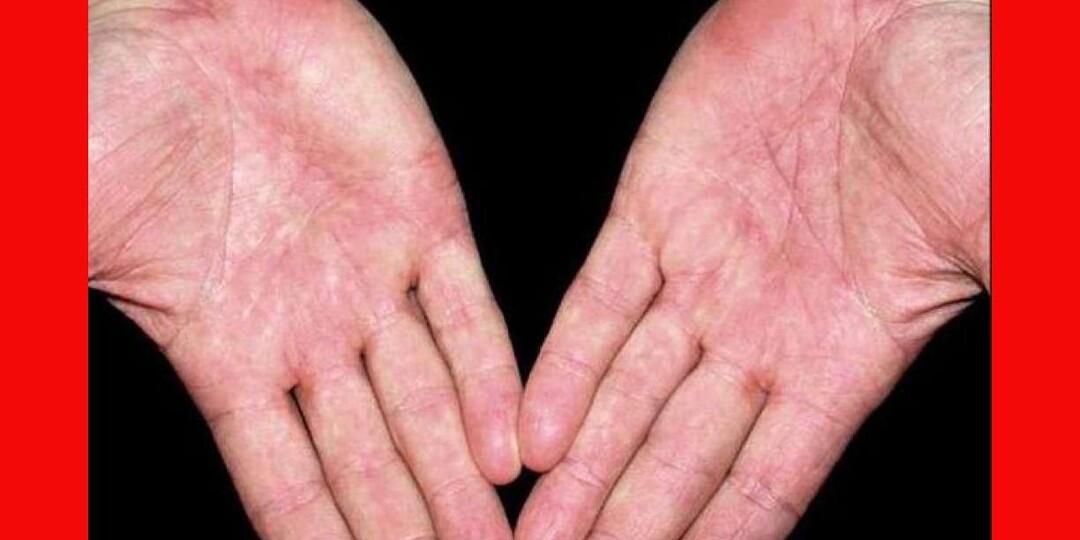 Ладони стали ярко-красными — на что обращают внимание врачи