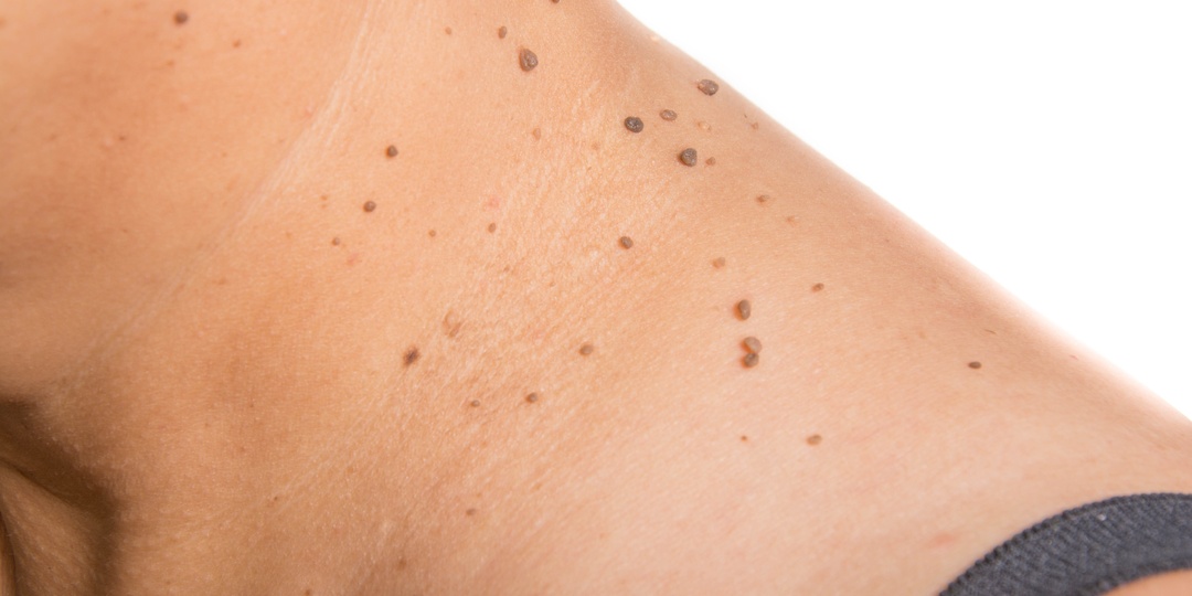 Появилось много мелких папиллом — как это связано с обменом