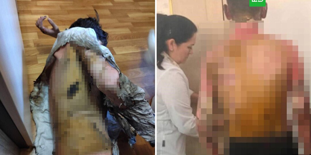 Пострадавшему в школе Красноярска подростку потребуется пересадка кожи