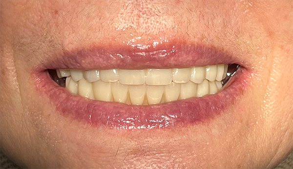 Результат имплантации в стоматологии Денталюкс