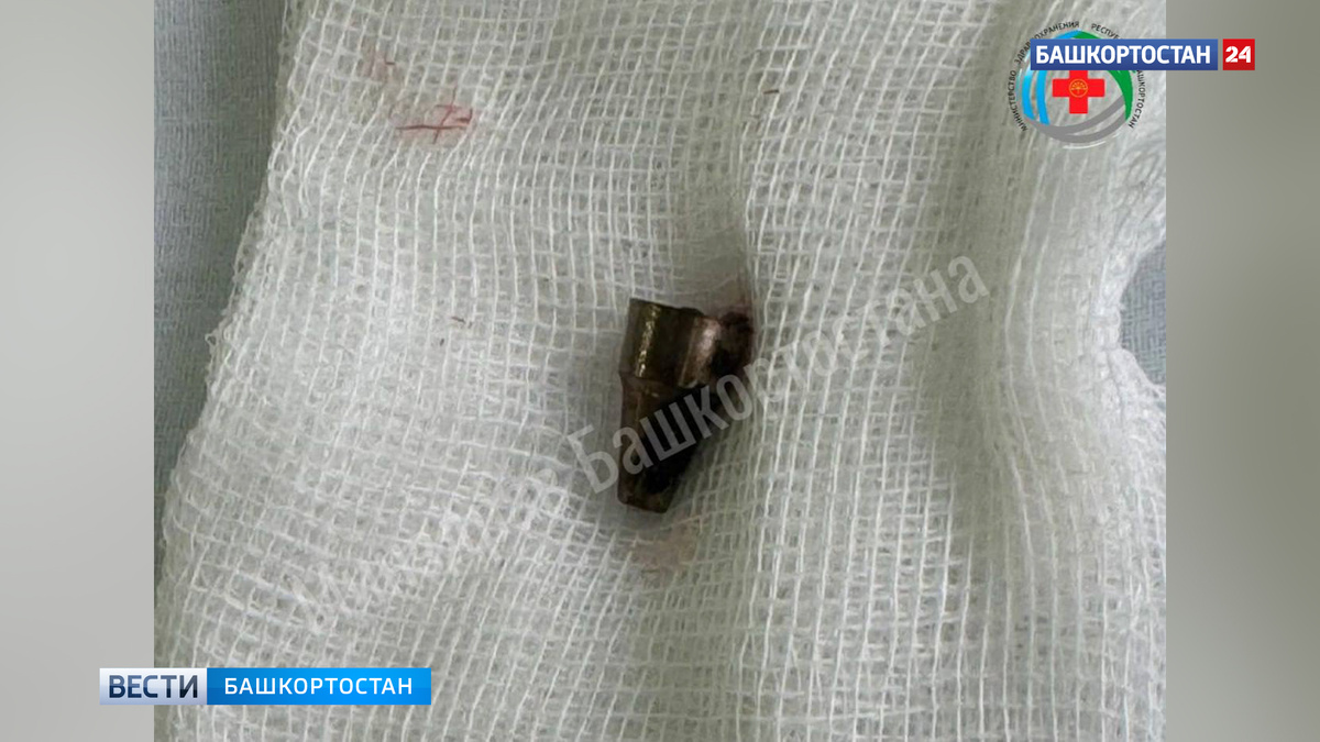    В Уфе хирурги извлекли из уха женщины металлический наконечник ручки