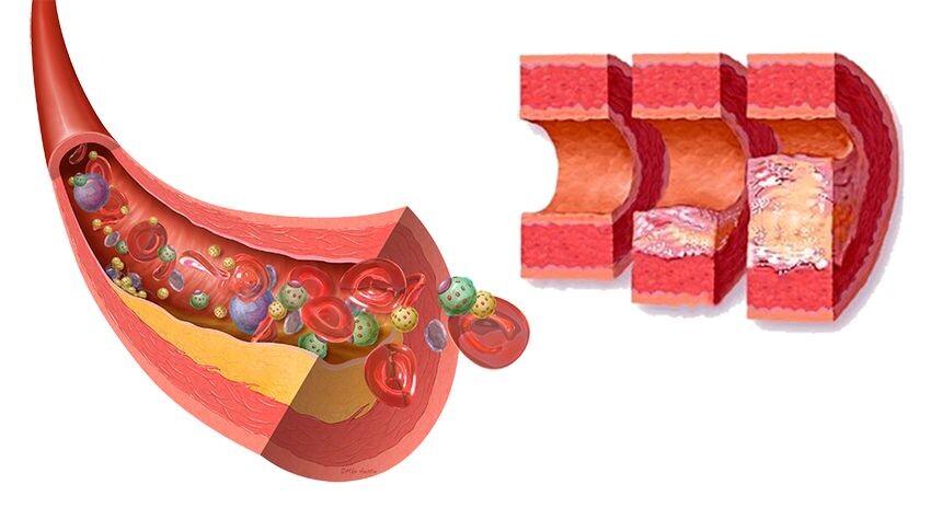 Атеросклероз и диабет: как разорвать «порочный круг» метаболических нарушений