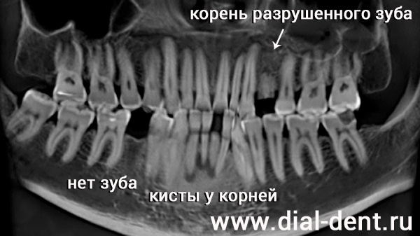 панорамный снимок зубов до лечения
