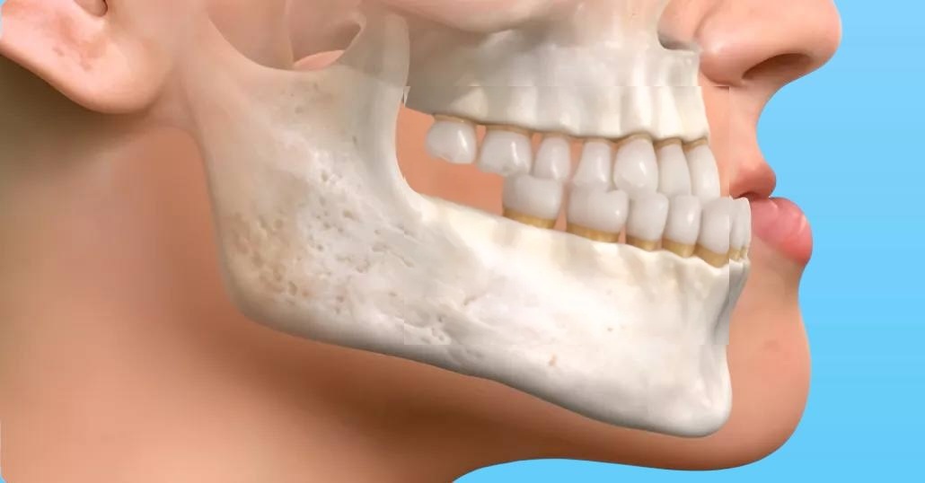 мезиальный тип