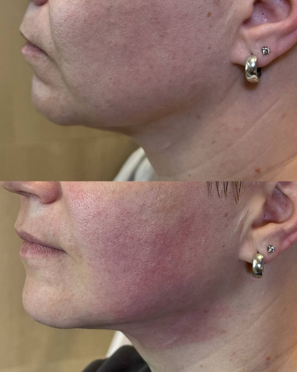 Реальное фото пациентки Клиники эстетической медицины «Гельтек»